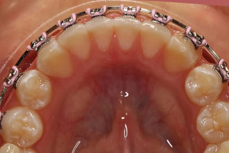 U ortho Niti Reverse Curve Archwire -Rectangular.