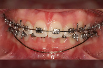 U ortho Niti Reverse Curve Archwire -Rectangular.