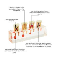 DENTical Study Model Root Canal Treatment M 4018 Buy Dental products Online DentalMyntra