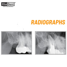 DiaDent DiaProseal - Epoxy Resin Based Root Canal Sealer Buy Dental products Online DentalMyntra