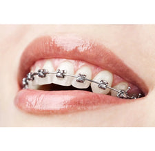 ET Dental MBT 022 Mini Brackets Kit (Non-Extraction) Buy Dental products Online DentalMyntra