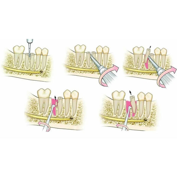 GDC Root Elevator Set Of 9 In Pouch Buy Dental products Online DentalMyntra