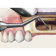 GDC Sinus Lifting Instrument Hollow Handle - 6 Buy Dental products Online DentalMyntra