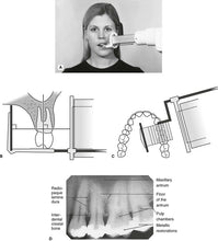 Indian RVG Sensor Positioner Buy Dental products Online DentalMyntra