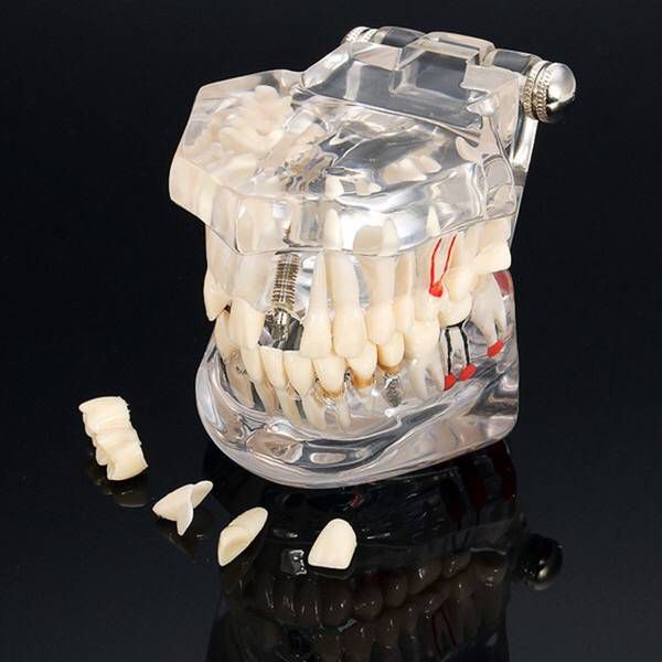 DENTAL ALL IN ONE IMPLANT MODEL