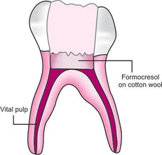 Maarc F-Sol Buy Dental products Online DentalMyntra