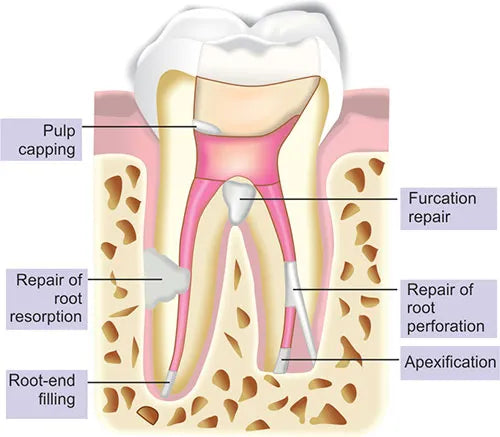 Maarc MTA Buy Dental products Online DentalMyntra