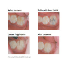 SDI Conseal F - Fluoride Releasing Pit & Fissure Sealant Buy Dental products Online DentalMyntra