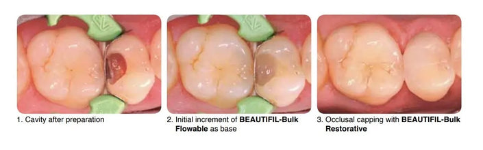 Shofu Beautifil Bulk Flowable Composite Buy Dental products Online DentalMyntra