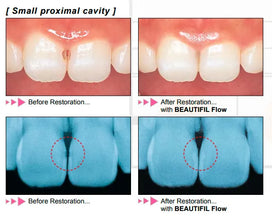 Shofu Beautifil Flow F02 Refill Buy Dental products Online DentalMyntra