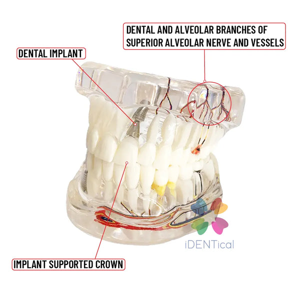 iDENTical Patient Education Model (Caries,implant,Nerves) M2001-3 Buy Dental products Online DentalMyntra