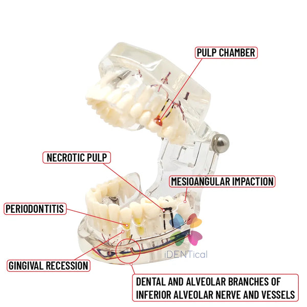 iDENTical Patient Education Model (Caries,implant,Nerves) M2001-3 Buy Dental products Online DentalMyntra